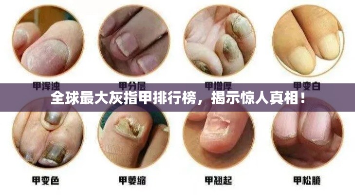 全球最大灰指甲排行榜，揭示惊人真相！