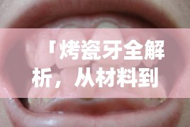 「烤瓷牙全解析，从材料到效果，你想知道的都在这里！」